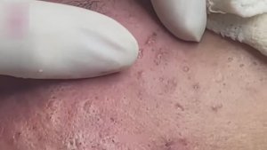 Очень глубокое удаление прыщей — от носа до рта, гной не заканчивался