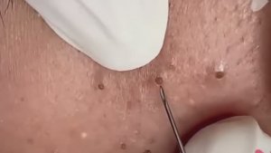 #193 Чистка лица от угрей и акне. Выдавливание прыщей. Удаление черных точек и комедонов