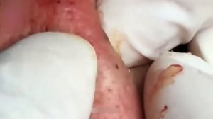 Чистка носа от черных точек — лучшее выдавливание прыщей на носу