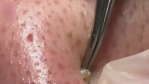 Удаление черных точек на носу