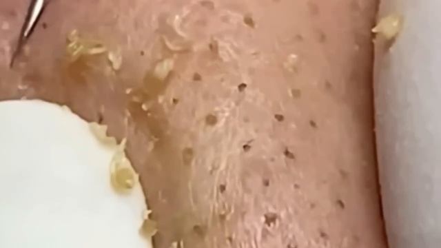 #196 Чистка лица от угрей и акне. Выдавливание прыщей. Удаление черных точек и комедонов