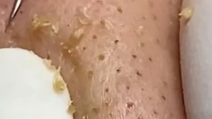 #196 Чистка лица от угрей и акне. Выдавливание прыщей. Удаление черных точек и комедонов