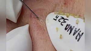 Выдавливание прыщей, угрей, черных точек и камедонов #294