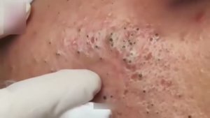 Удаление черных точек на щеке и носу