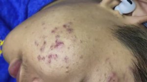 034 • Relax Spa • АСМР • Acne collection