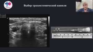 УЗИ и трахеостомия Щепарев И.С.