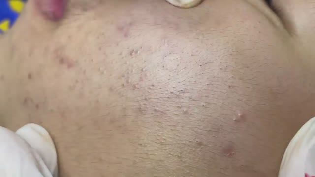 033 • Relax Spa • АСМР • Acne Collection