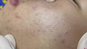 033 • Relax Spa • АСМР • Acne collection