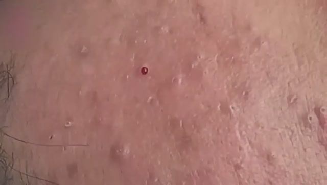 Очень глубокое удаление прыщей. Часть 1