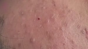 Очень глубокое удаление прыщей. Часть 1