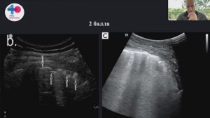 Пост-опрац Ателектазы Щепарев И.С.