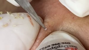 Выдавливание прыщей, угрей, черных точек и камедонов #293