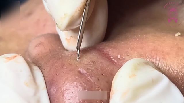 Экстремальное удаление черных точек на носу. Невероятно приятное выдавливание!