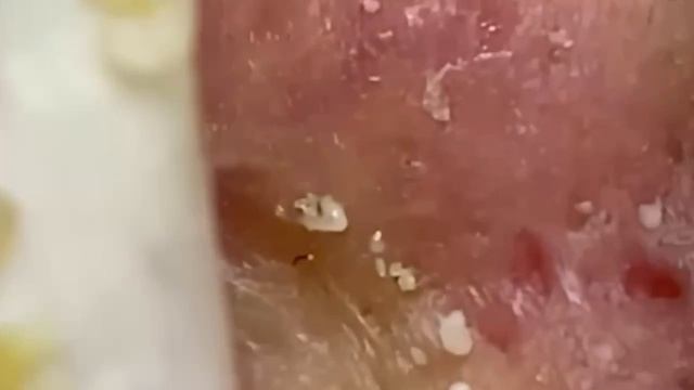 #197 Чистка лица от угрей и акне. Выдавливание прыщей. Удаление черных точек и комедонов