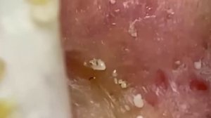 #197 Чистка лица от угрей и акне. Выдавливание прыщей. Удаление черных точек и комедонов