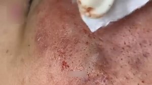 Удаление черных точек: максимальное удовлетворение от выдавливания