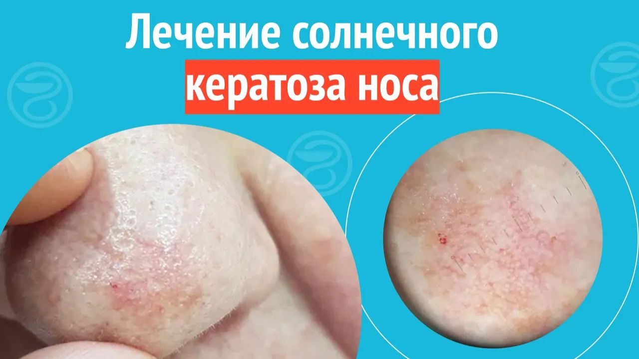 🩺 Лечение солнечного кератоза носа. Клинический случай №1420 смотреть онлайн