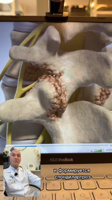 Что такое спондилез?