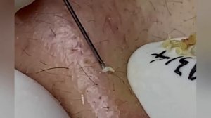 Выдавливание прыщей, угрей, черных точек и камедонов #298