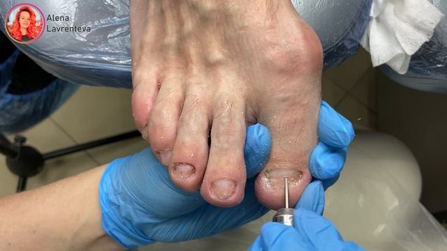Грибок на ногтях. Что делать при грибке ног. Микоз на пальцах . Онихомикоз. Подология. Педикюр