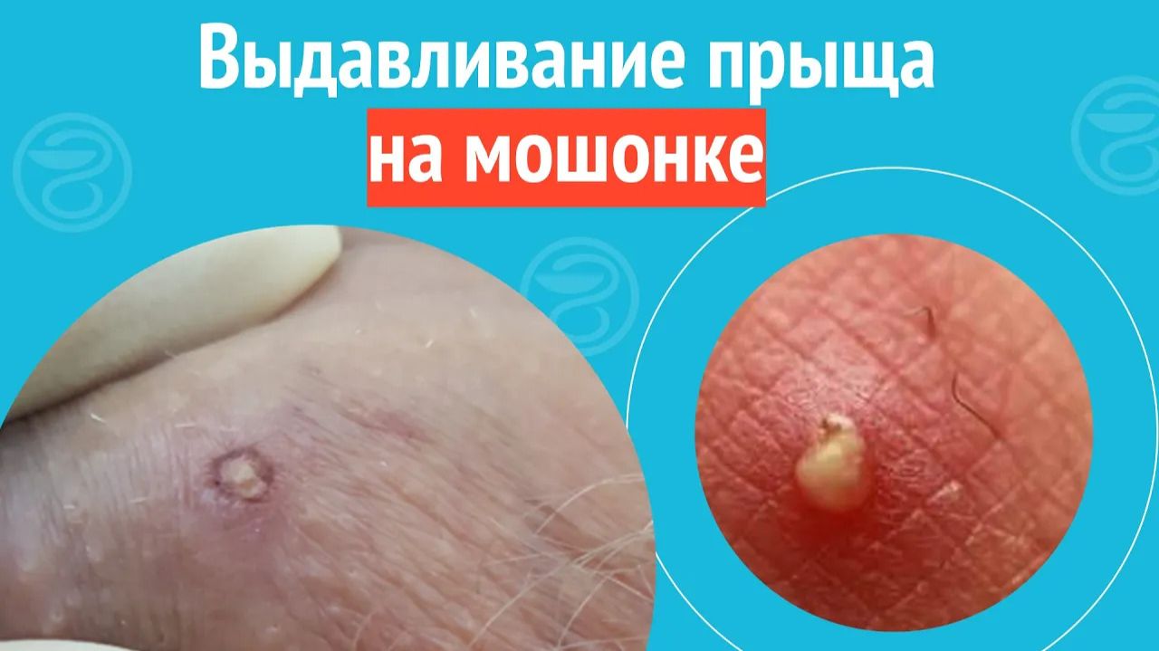 🫤 Выдавливание прыща на мошонке. Клинический случай №1411 смотреть онлайн