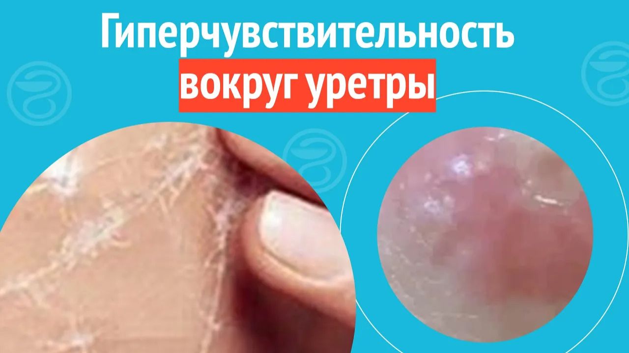 😢 Гиперчувствительность вокруг уретры. Клинический случай №1417 смотреть онлайн