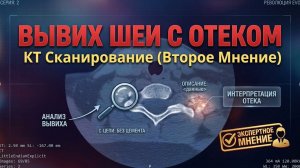 БОЛЬ В ШЕЕ (отек), ПОДВЫВИХ шейных позвонков и АНТЕЛИСТЕЗ С4 на РАСШИФРОВКЕ КТ шейного отдела
