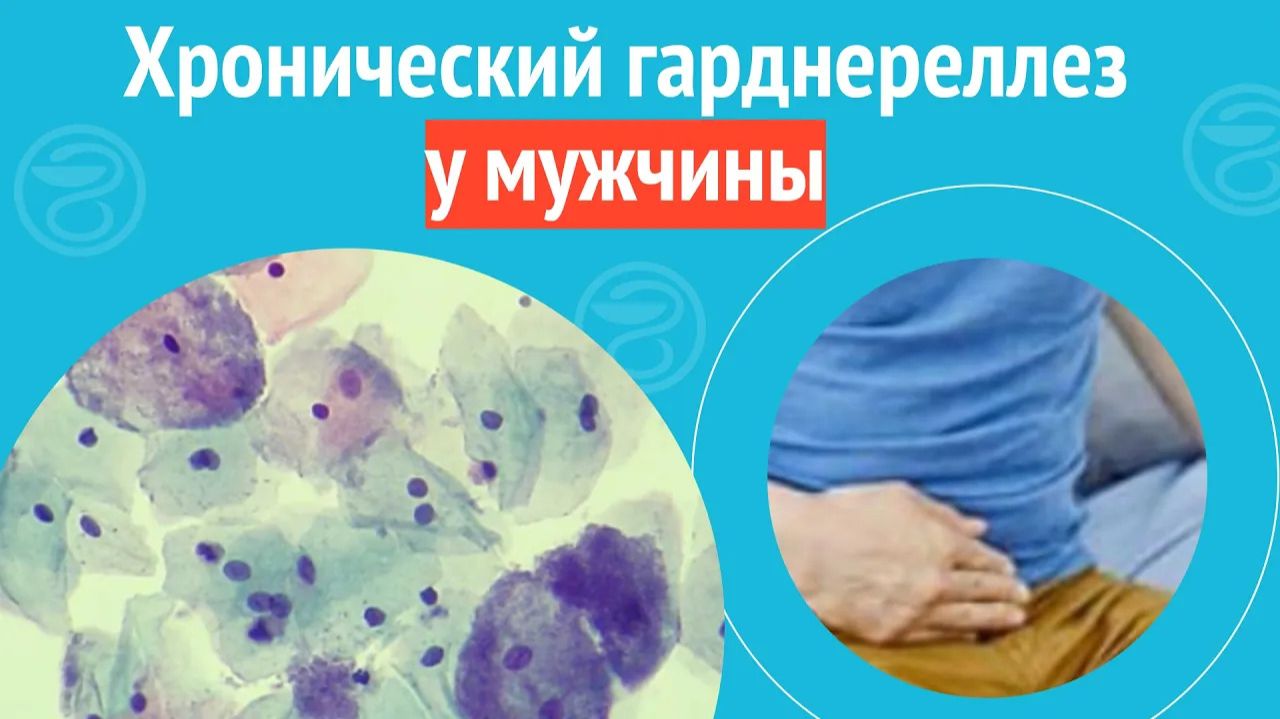 👨🦲 Хронический гарднереллез у мужчины. Клинический случай №1409 смотреть онлайн