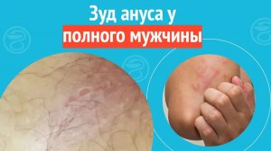 😢 Зуд ануса у полного мужчины. Клинический случай №1413