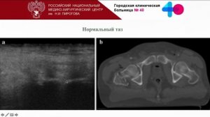 УЗИ симфиза Щепарев И.С.