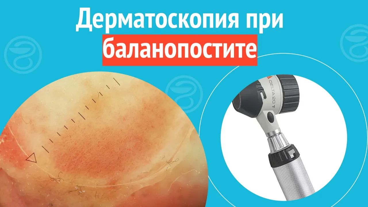 🔎 Дерматоскопия при баланопостите. Клинический случай №1408 смотреть онлайн