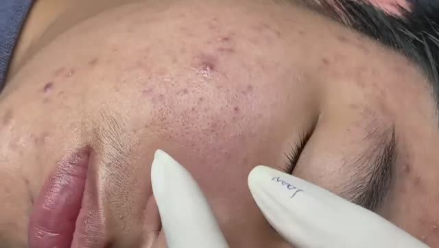 Чистим кожу от закрытых комедонов. Расслаблющее видео.