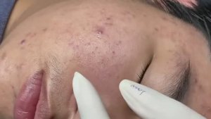 Чистим кожу от закрытых комедонов. Расслаблющее видео.