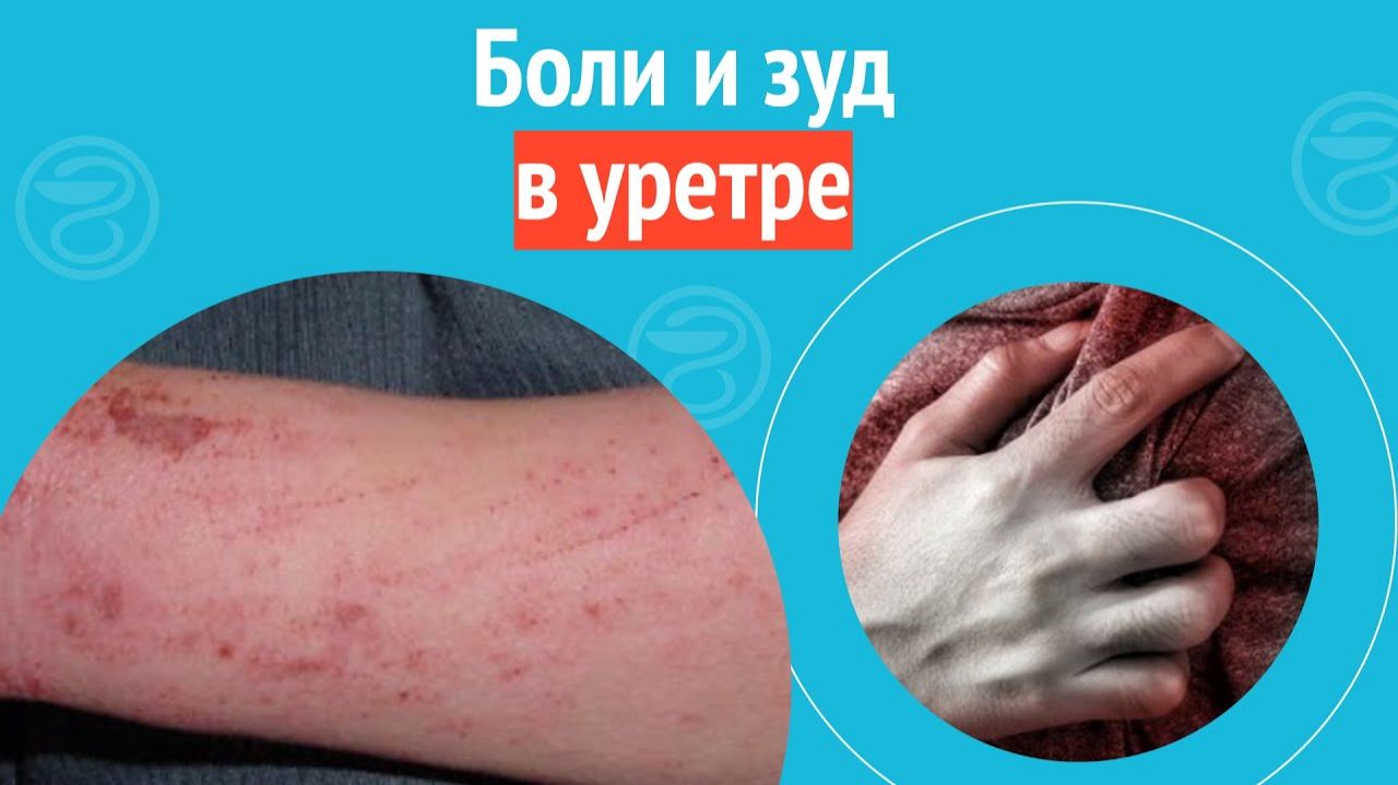 😕 Боли и зуд в уретре. Клинический случай №1415 смотреть онлайн