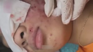 Удаление черных точек: самые приятные моменты