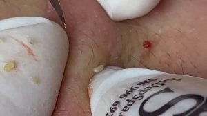 Выдавливание прыщей, угрей, черных точек и камедонов #296