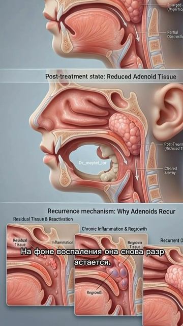 Про аденоиды в моем бесплатном канале Ссылка в описании канала ПОДПИШИСЬ #лор #аденоиды #здоровье
