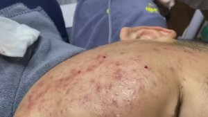 Asmr. Избавление от подкожных угрей.