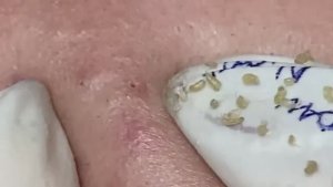 Asmr. Чистка лица от подкожных угрей.