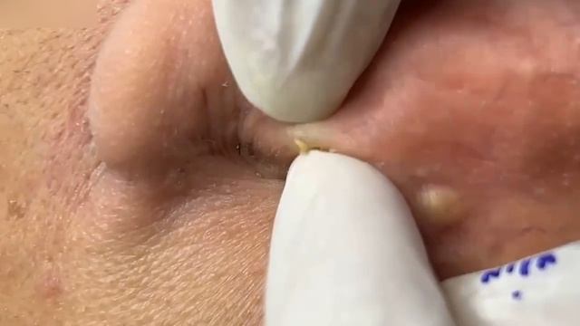 Удаление комедонов и акне #887619