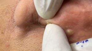 Удаление комедонов и акне #887619