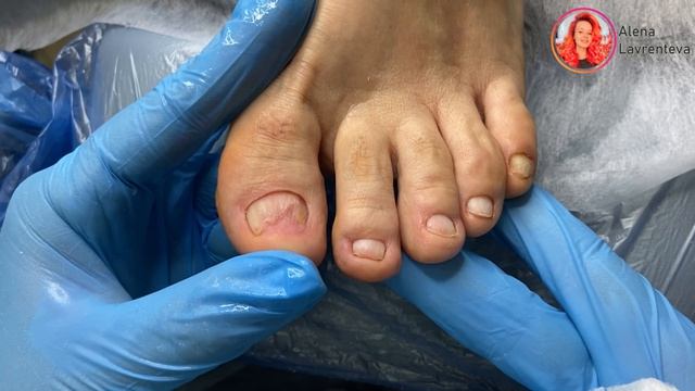 Грибок подтвержден. Что делать дальше. Повторный визит. Зачистка