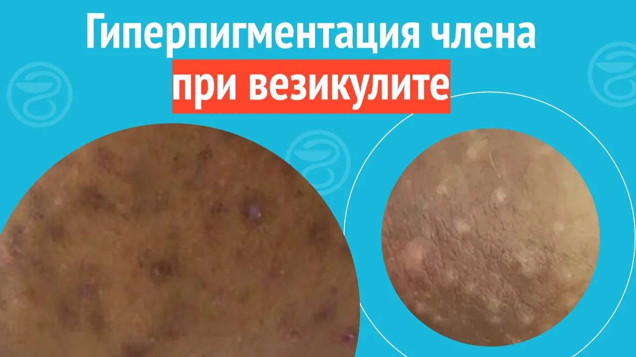 ➡️ Гиперпигментация члена при везикулите. Клинический случай №1427 смотреть онлайн