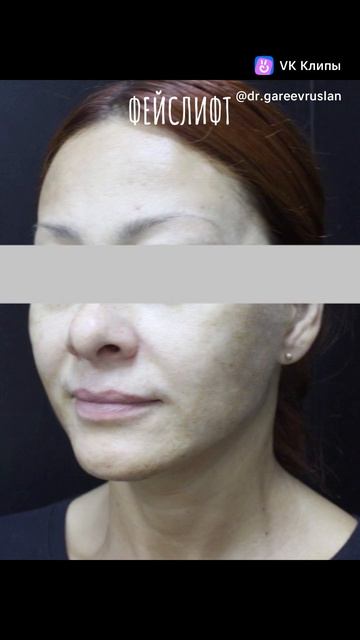 Результат комплексной работы с возрастными изменениями лица