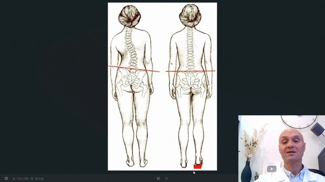 Короткая нога- причина сколиоза. Как это связано?