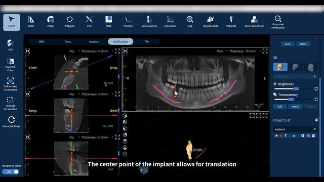 Eighteeth FinScan F350 — Virtual Implantation смотреть онлайн