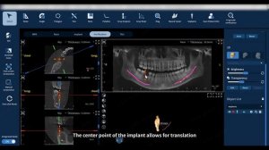 Eighteeth FinScan F350 — Virtual Implantation
