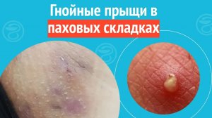 👉 Гнойные прыщи в паховых складках. Клинический случай №1450