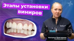 На какой цемент приклеить виниры? Эстецем 2 плюс/ Estecem Il Plus