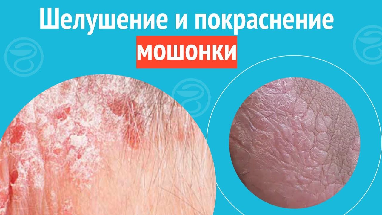 😯 Шелушение и покраснение мошонки. Клинический случай №1422 смотреть онлайн